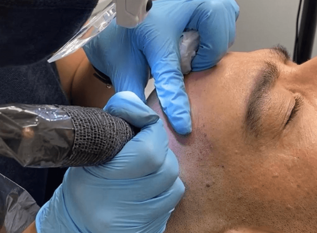 What Scalp Micropigmentation Can Do for Men