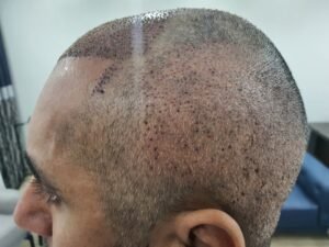 Hair Transplant