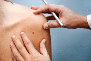 Moles Removal in Dubai