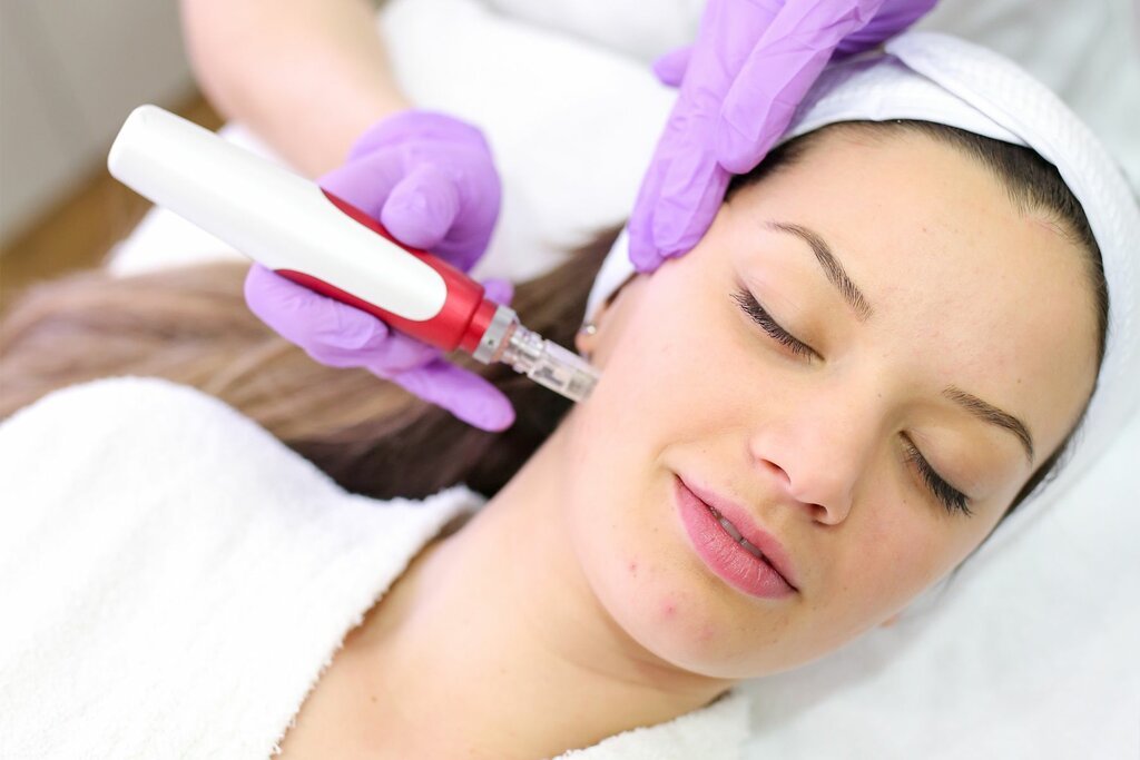 Microneedling