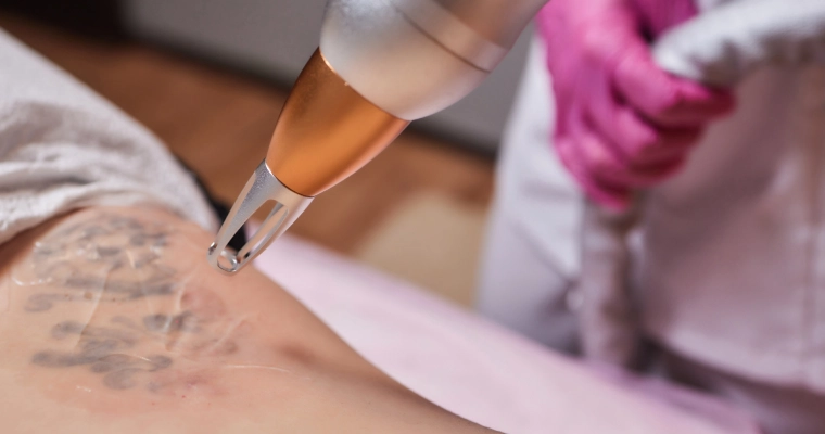 How Painful Is Tattoo Removal Abu Dhabi Treatment?