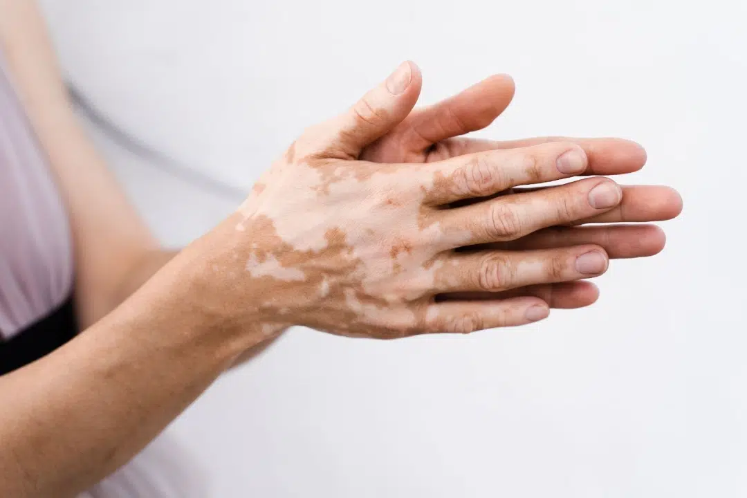 Is Vitiligo Treatment Permanent or Temporary?