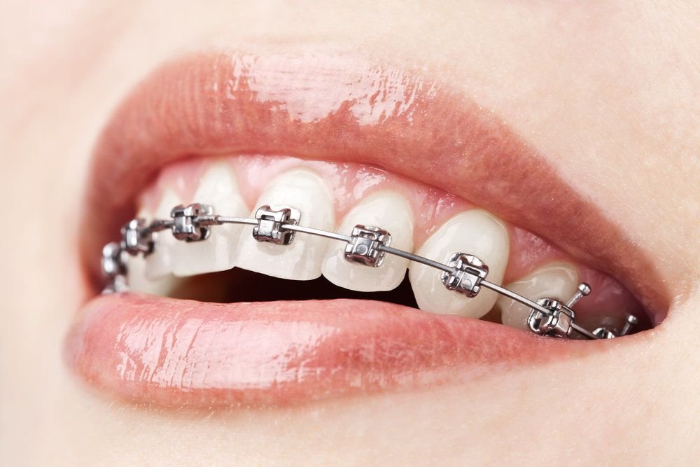 What Benefits Come with Dental Braces
