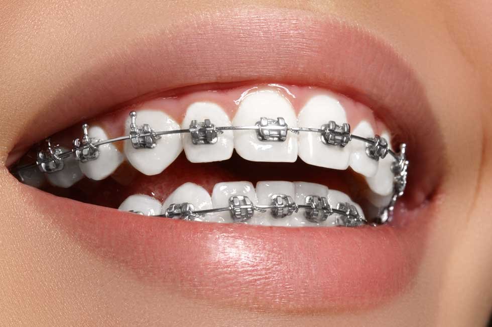 What Results to Expect from Dental Braces