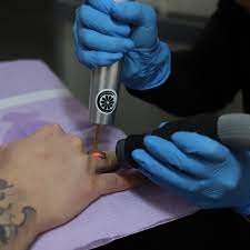 tattoo removal