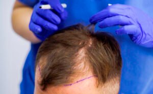 زراعة الشعر في الرياض