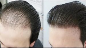 زراعة الشعر في الرياض