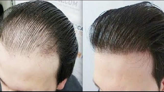 زراعة الشعر في الرياض