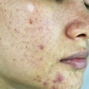 Acne Removal Dubai: Combining Skincare & Diet