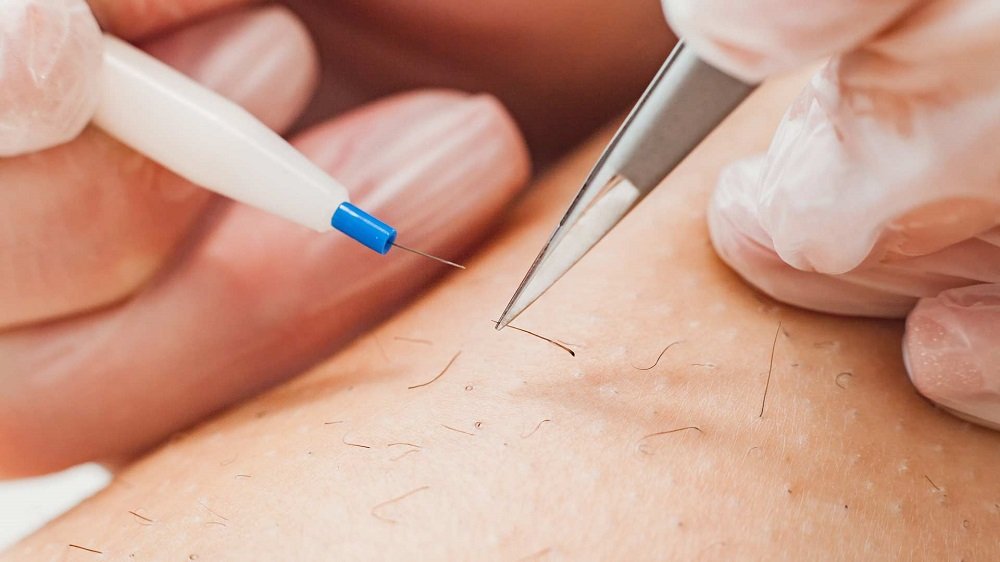 Is Electrolysis Hair Removal Safe for Sensitive Skin