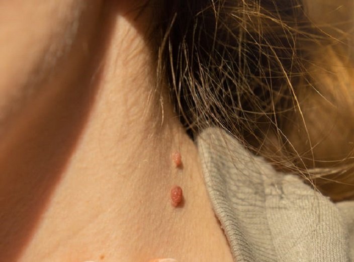 Skin Tag Removal in Dubai: Modern Dermatology Solutions