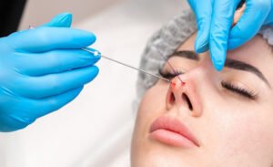 What Results to Expect from Hiko Nose Thread Lift