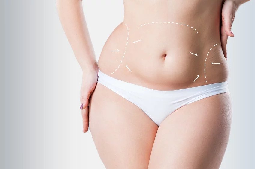 What Results to Expect from a Tummy Tuck