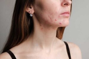 How Acne Scar Treatment Restores Smooth Skin