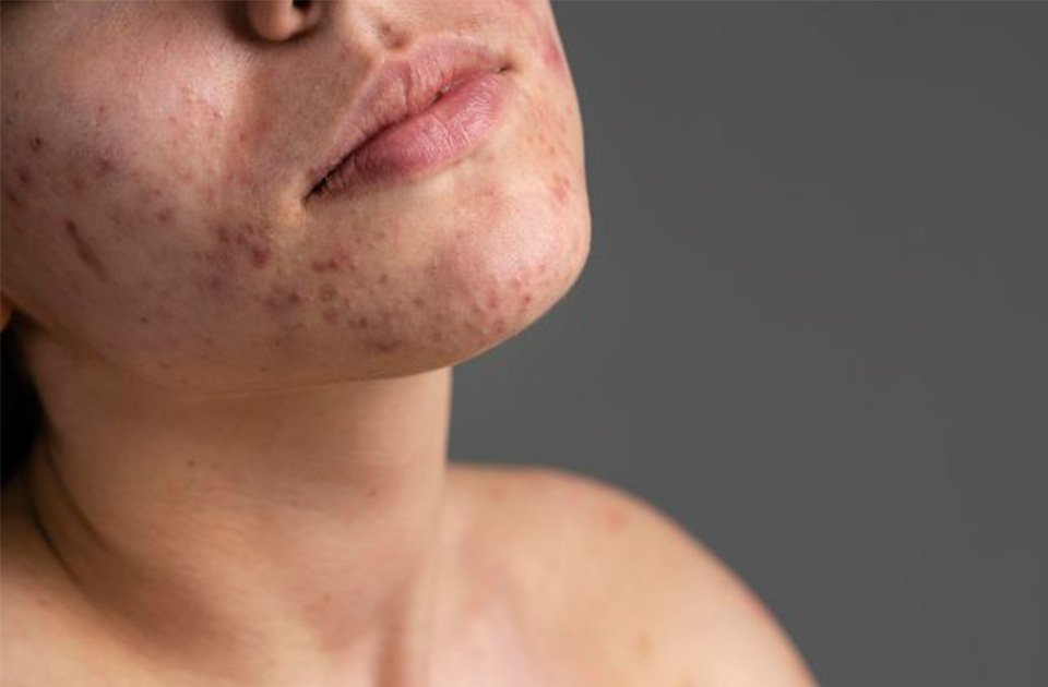 How Acne Scar Treatment Supports Skin Renewal