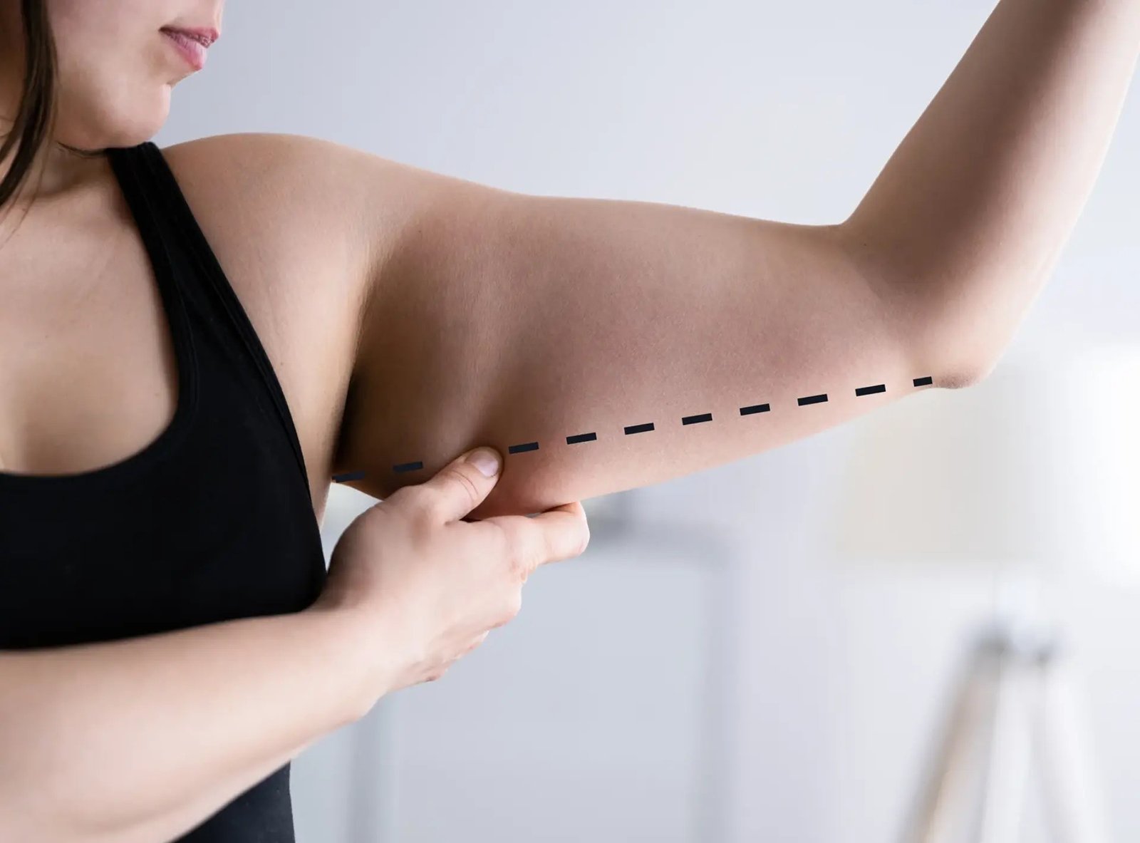 How Arm Lift Improves Upper Arm Contours