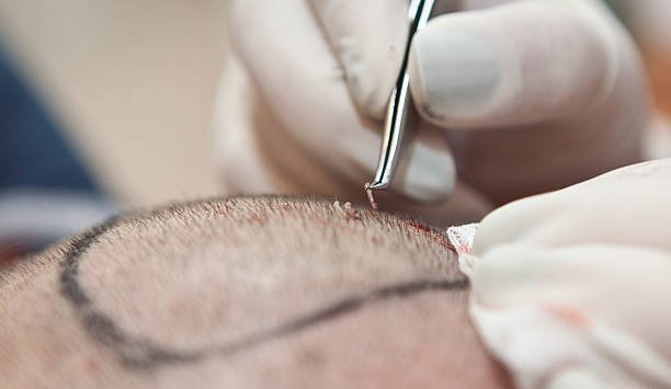 How Hair Transplant Minimizes Visible Scars