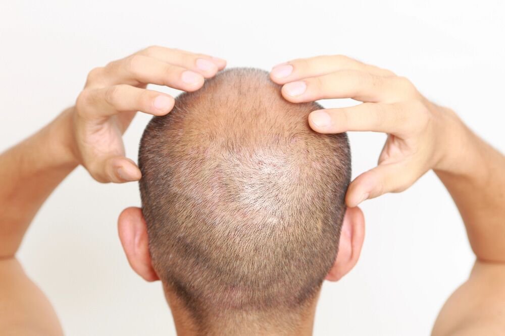 How Long Does Scalp Micropigmentation Last