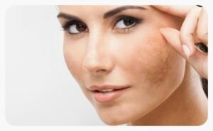 How Melasma Treatment Improves Uneven Skin Tone