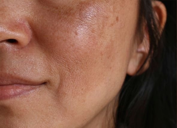 How Pigmentation Treatment Improves Skin Tone