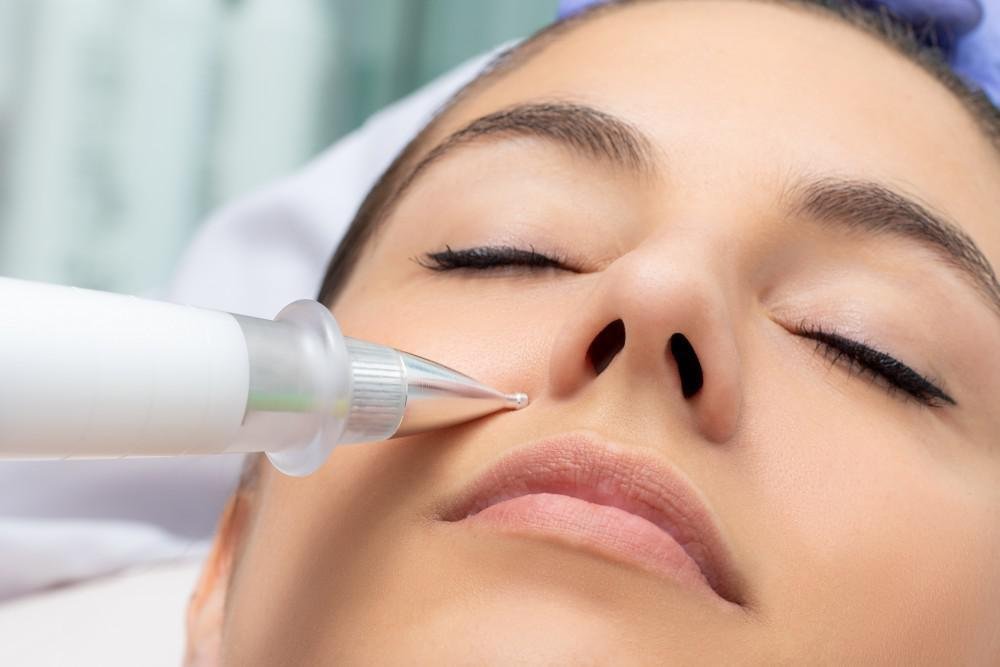How Plasma Pen Treatment Improves Skin Tone