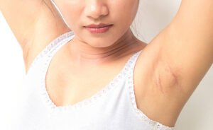 How Underarm Whitening Treatment Improves Tone