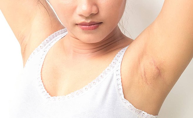 How Underarm Whitening Treatment Improves Tone