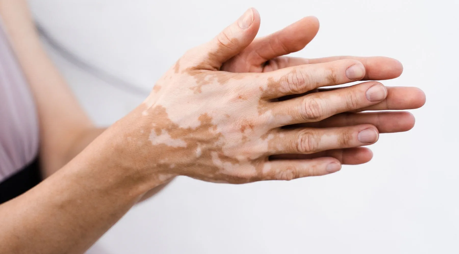 How Vitiligo Treatment Works on White Patches