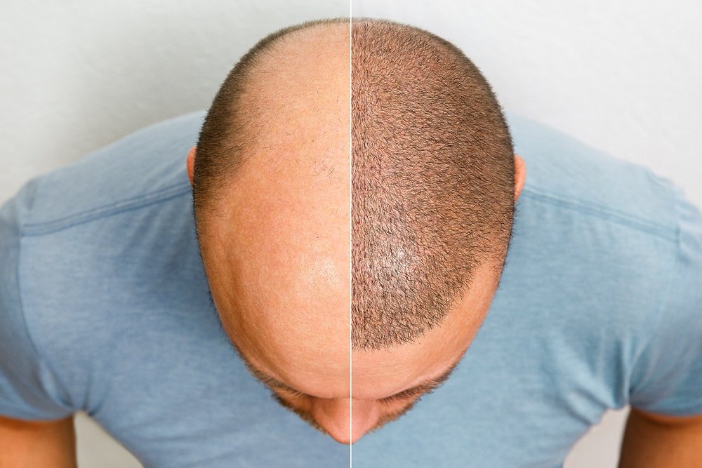 Is Scalp Micropigmentation Worth It