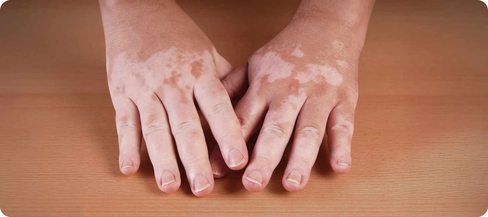 What Age Is Best to Start Vitiligo Treatment