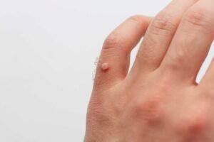What Results to Expect from Warts Removal