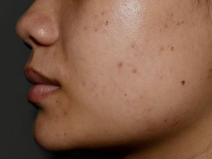 What Skin Issues Pigmentation Treatment Solves