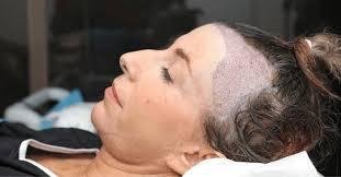 Hair Transplant