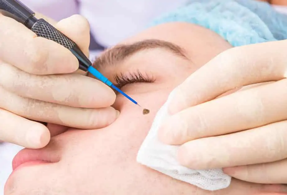 Does Mole Removal Require Downtime