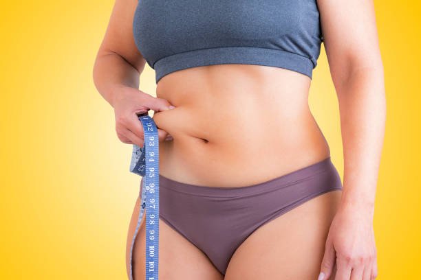 Does Tummy Tuck Surgery Remove Stretch Marks?