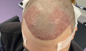How Hair Transplant Improves Hair Density
