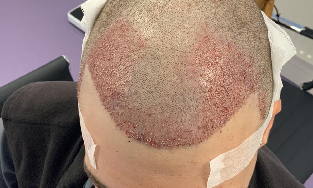 How Hair Transplant Improves Hair Density