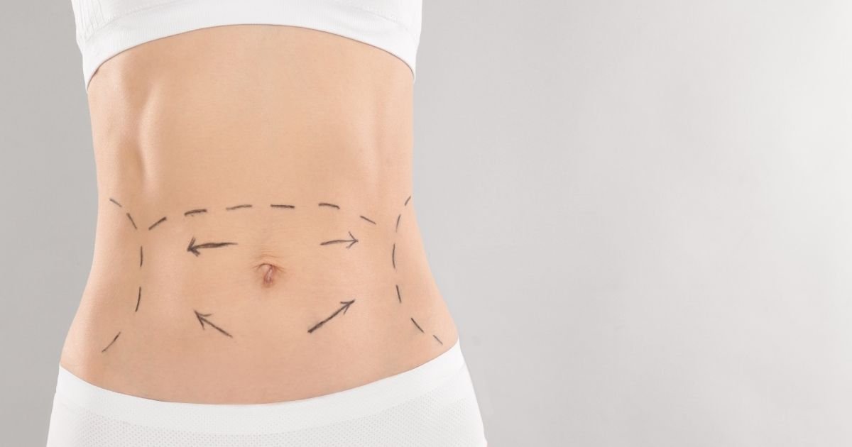 How Lipo Abdominoplasty Creates Natural Results
