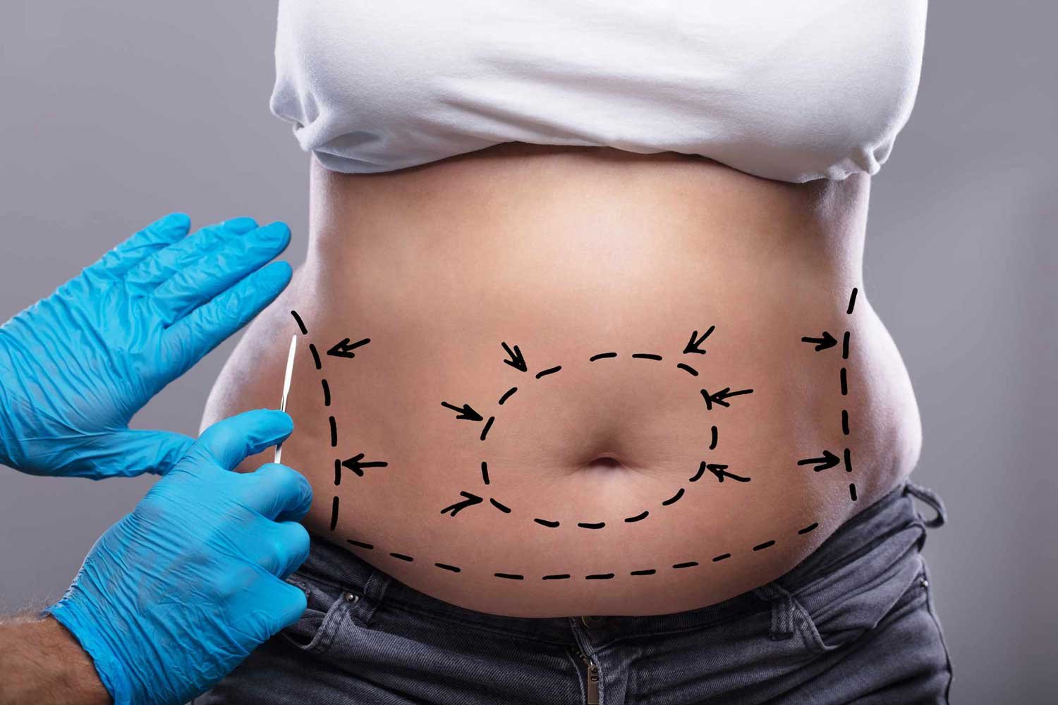 How Lipo Abdominoplasty Improves Body Contours
