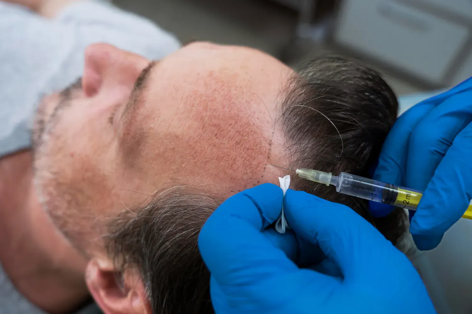 How Long Does Exosomes Hair Treatment Last?