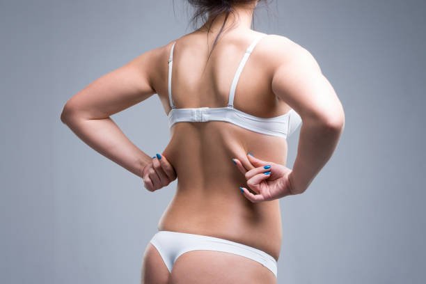How Long Does Liposuction Surgery Recovery Take?