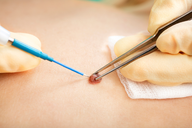 How Mole Removal Helps Detect Skin Cancer