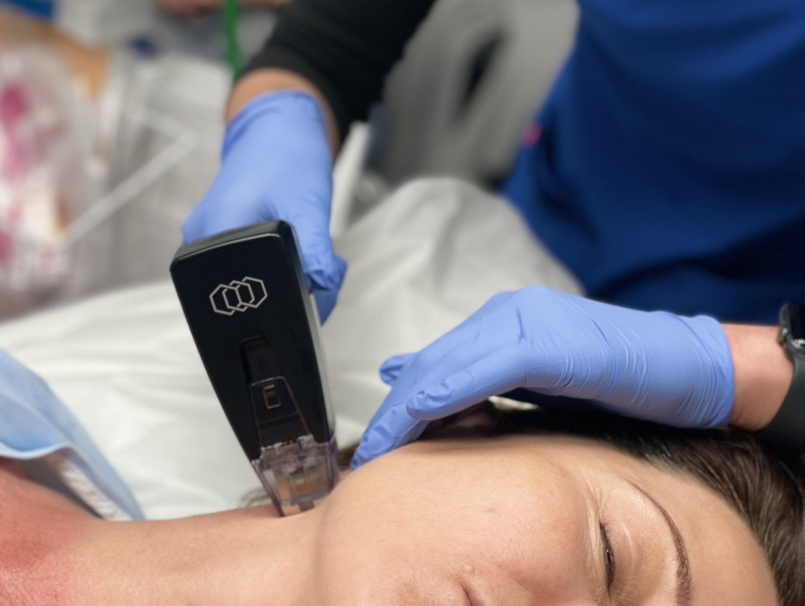 How Morpheus8 Stimulates Collagen Production