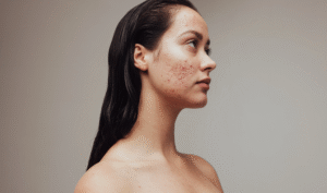 How Soon Does Acne Treatment Work