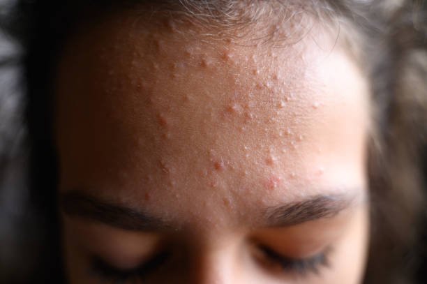 Is Acne Treatment Worth It for Adults?