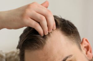 What Age Is Best for Hair Transplant Surgery