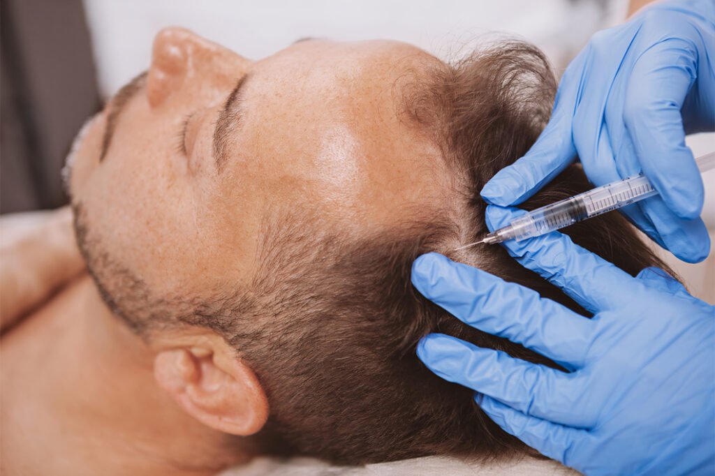 What Areas Can Exosomes Hair Treatment Cover