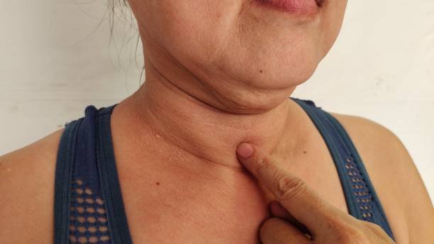 What Is the Best Age for Double Chin Liposuction?