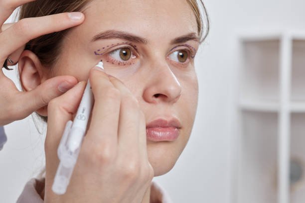 Does Eyelid Surgery Leave Noticeable Scars?