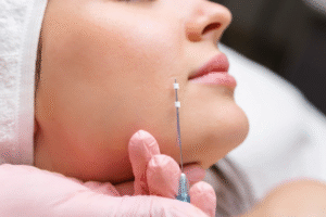 How Effective Is Thread Lift Treatment?